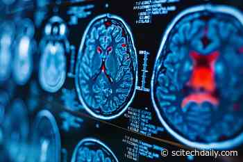 Unlocking Alzheimer’s: Memory Complaints Can Predict Biological Changes in the Brain