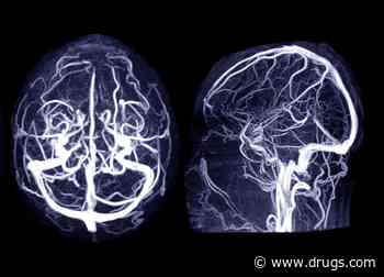 What Is a Cerebral Aneurysm? What Are the Signs?