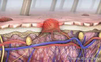 ASCO: Neoadjuvant Ipilimumab + Nivolumab Ups Survival in Resectable Melanoma