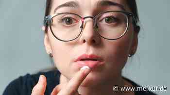 „Enttäuschendes“ Ergebnis bei Stiftung Warentest – Kein einziges Produkt gegen Herpes bekommt eine Empfehlung