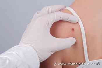 Five mole changes you should get checked as Kevin Jonas shares skin cancer diagnosis