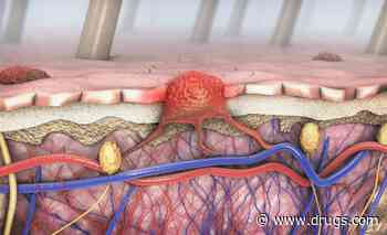 Nonsignificant Survival Benefit Seen for Dabrafenib, Trametinib in Melanoma