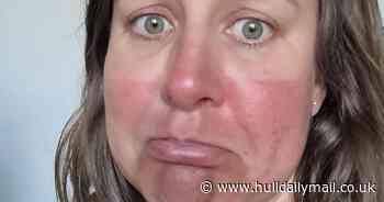 Pale mum left 'looking like drumstick lolly' after disastrous sunburn fail while reading in her garden