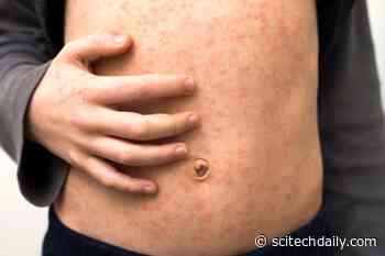 Stopping Measles Cold: Groundbreaking Insights From Cryo-EM