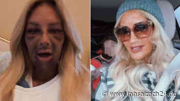 „Ich sah aus wie ein Monster“: Model und Mama Jessica nach Zahn-OP völlig entstellt