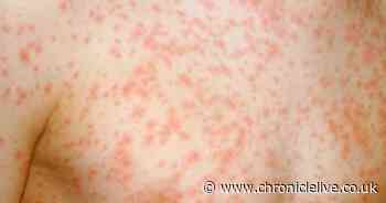 Three early warning signs of measles to look out for in your children as infections rise