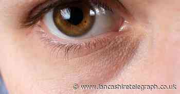 How to get rid of dark circles under your eyes: 5 tips