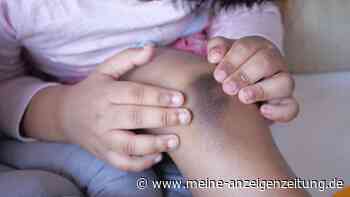 „Es ist nur ein offenes Knie?“: Vater total verblüfft, dass Kinder keine feste Kniescheibe haben