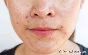 Direct CGRP Inhibition Cuts Acne, Rosacea in Patients With Migraine