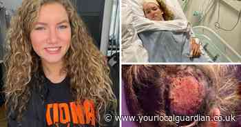 Bromley girl's Taylor Swift hairstyle causes severe burn