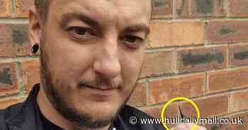 Dad's life-saving op 9 weeks after dentist dropped drill bit down throat