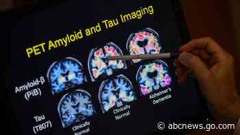 Blood tests for Alzheimer's may be coming to your doctor's office. What to know