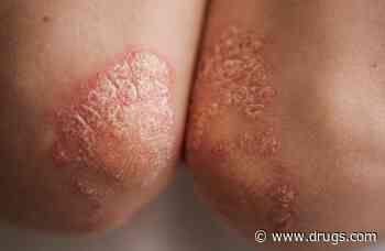 Psoriasis, Psoriatic Arthritis Tied to Higher Risk of Polyneuropathy