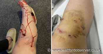 Hertfordshire 'XL Bully' attack leaves woman bloodied and bruised