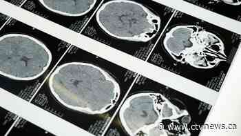 Groundbreaking research may change how we treat one of the most aggressive forms of brain cancer