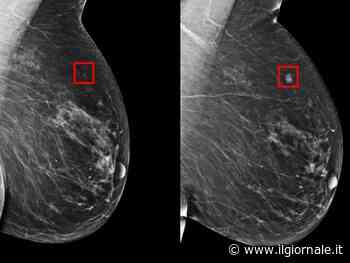 Rilevare il cancro al seno cinque anni prima: il test in tre ospedali