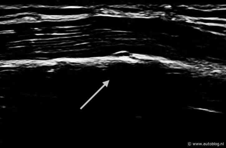 Oscar Piastri won Grand Prix met gebroken rib