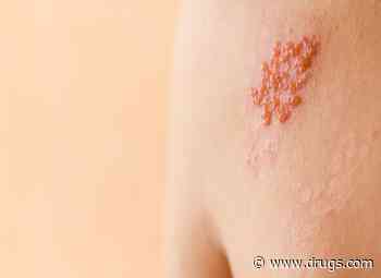 Bout of Shingles May Raise Odds for Cognitive Decline