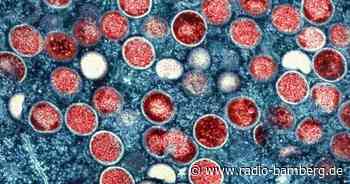 WHO ruft wegen Mpox weltweite Notlage aus