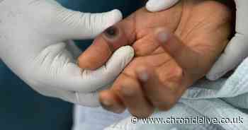 Mpox outbreak prompts global health emergency declaration by WHO