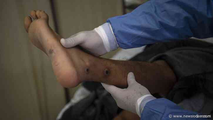 Opmars van nieuwe apenpokkenvariant aangemerkt als internationale noodsituatie