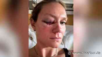 Nach Unfall: Olympia-Star postet Schock-Fotos aus dem Krankenhaus