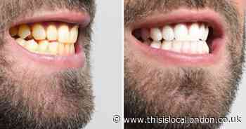 Professional teeth whitening in Turkey
