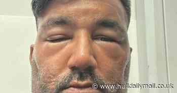 Dad's bid to 'look younger' with hair dye for wedding backfires - as head swells so much guests tell him to go to hospital