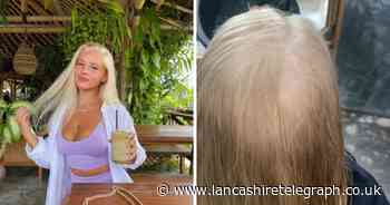 Woman warns holidaymakers to carry water filter abroad after her hair falls out