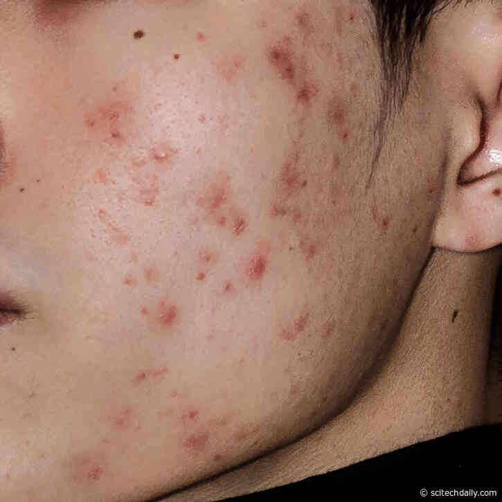 Bamboo Vinegar: Scientists Discover New Natural Anti-Acne Solution