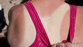 Does Your Skin Have Sun Damage? We Asked Experts if You Can Reverse It