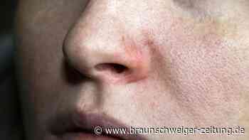 Nasen-Ausschlag? Diese schwere Krankheit kann schuld sein