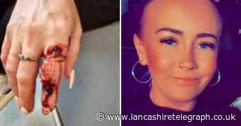 'It will kill a child': Mum lucky to escape with finger intact after XL Bully attack