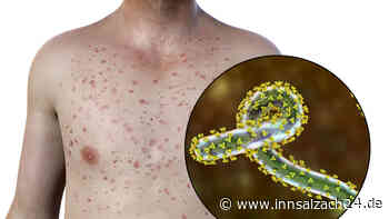 Marburg-Virus-Verdacht in Hamburg: Die Anzeichen der heimtückischen Tropenkrankheit