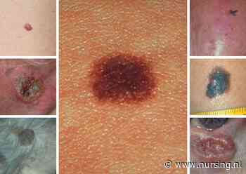 Melanoom of iets onschuldigs? Zo herken je deze 7 huidletsels