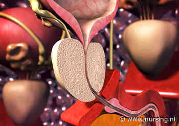 Tiemann blaaskatheter: 3 veelgestelde vragen