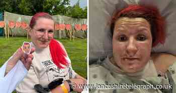 Holidaymaker's insurance warning as she is refused pay out after horrific burns