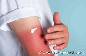 What You Need to Know About Sun Poisoning and How to Prevent It