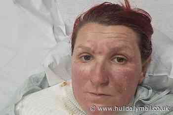 Holidaymaker not covered for horrific burns because of how they happened