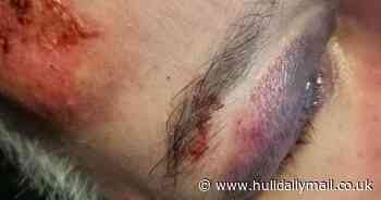 Grandad breaks spine tripping on pothole reported to council years ago