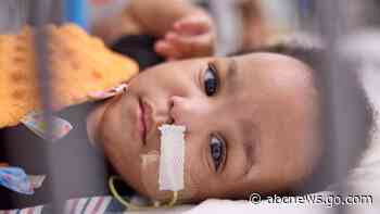 Twin boys born conjoined celebrate 1st birthday after separation surgery