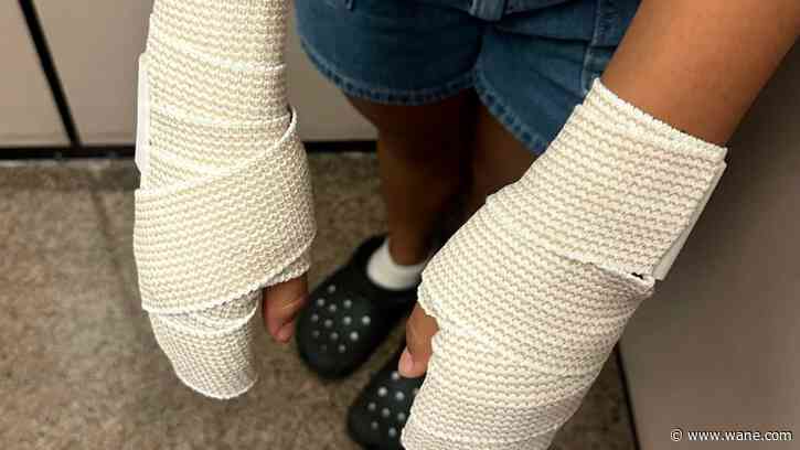 Texas middle school cheerleaders suffer first and second degree burns after 'punishment' from coach