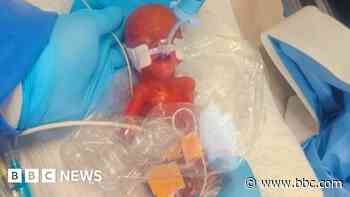Tiny baby kept in sandwich bag finally goes home