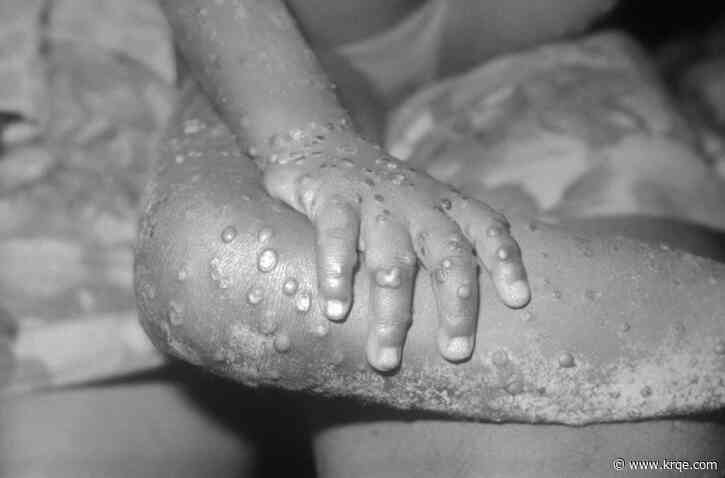 City of El Paso confirms two cases of Mpox