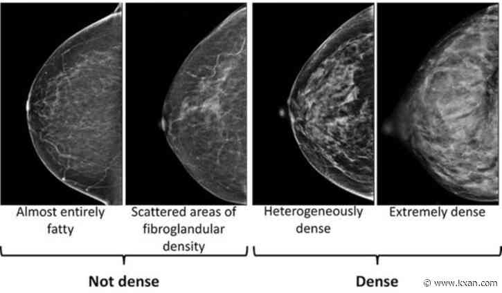 Breast density increases breast cancer risk, according to health experts