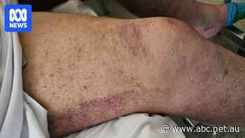 Australian man diagnosed with scurvy, a disease doctors 'thought we had eradicated'