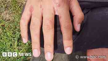 GPs advise not to ignore scabies symptoms