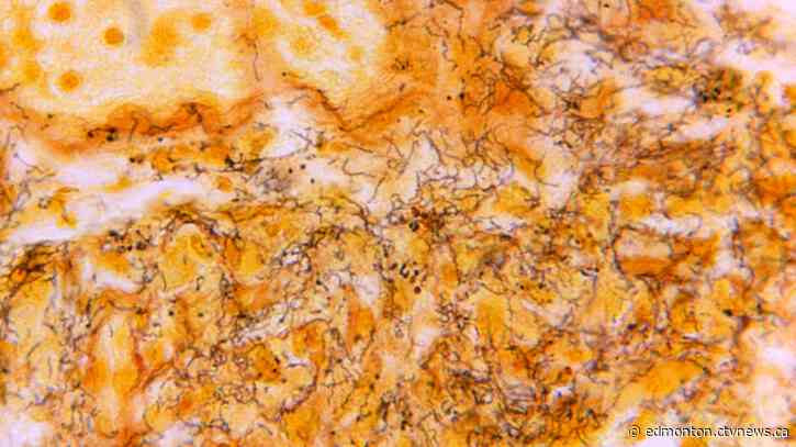 After years of outbreak, Alberta sees decline in syphilis rates