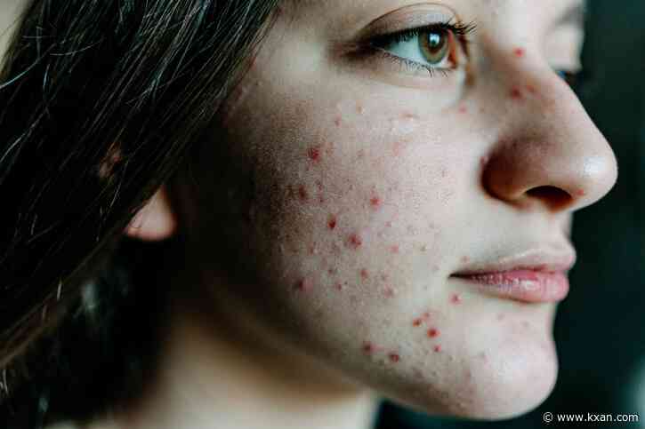 Experts link sleeplessness, anxiety, depression to Eczema