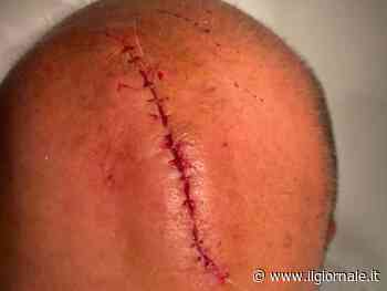 Altro che graffio, le immagini choc in tv. Sangiuliano ferito nella lite con la Boccia